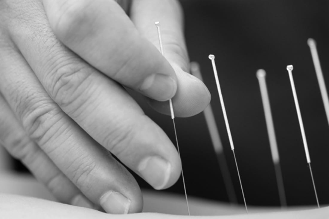Acupuncture in Medina, TN